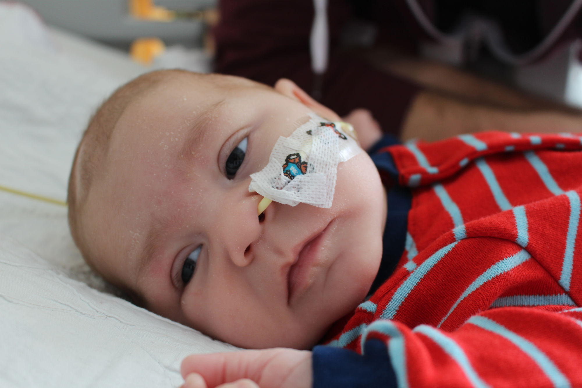 Félip with an NG-tube in his nose