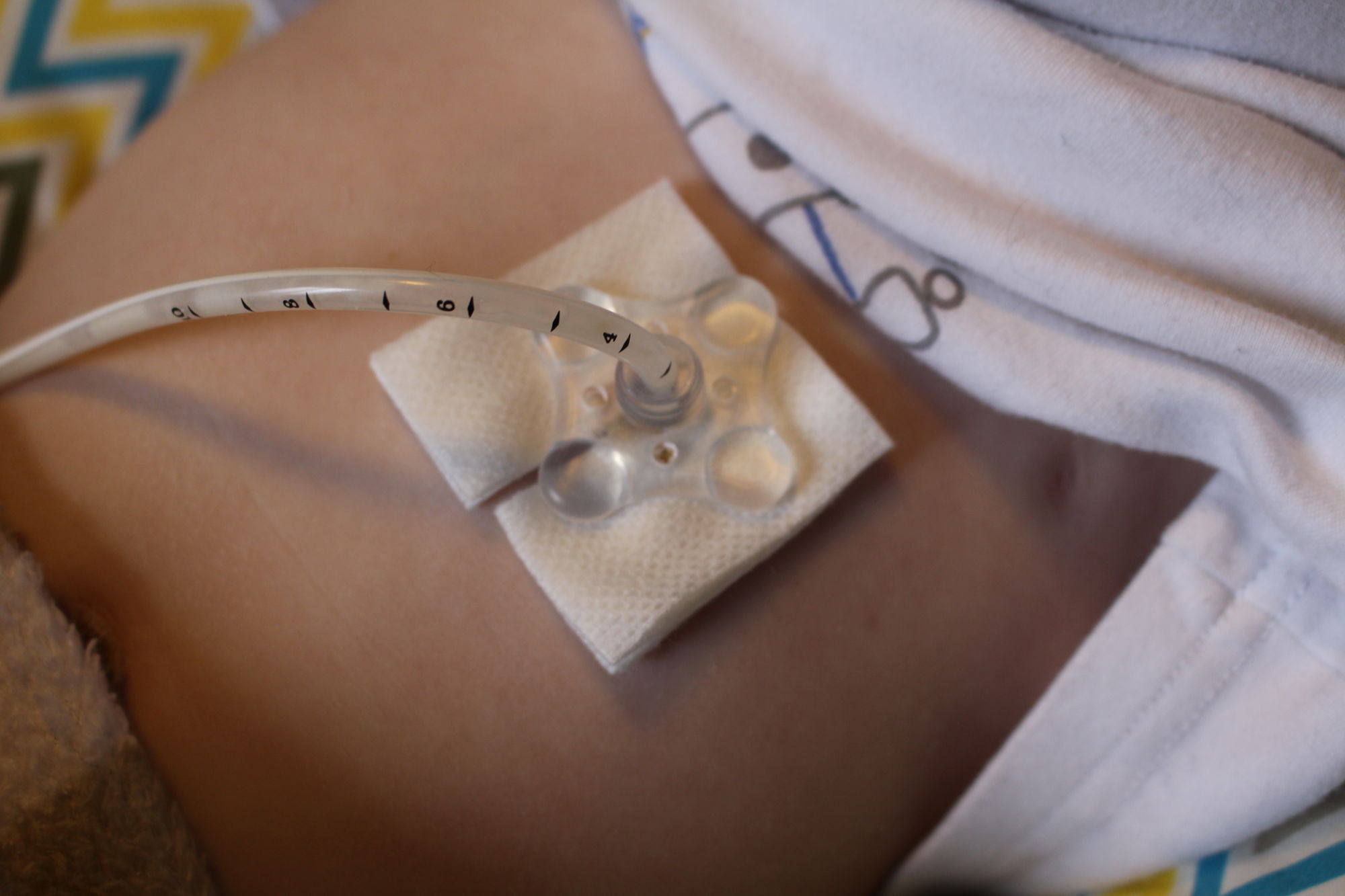 Félip's PEG G-tube after surgery